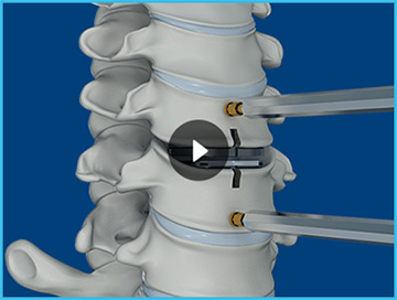 ARTIFICIAL DISC REPLACEMENT